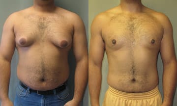 Are Your Man Boobs Freaking You Out Bodify Coolsculpting Medical Spa