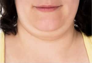 double chin can be fixed by CoolSculpting at bodify