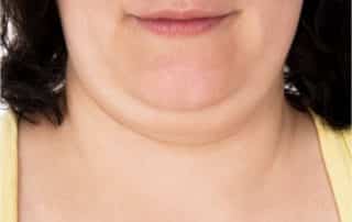 double chin can be fixed by CoolSculpting at bodify