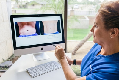 Does CoolSculpting really truly work
