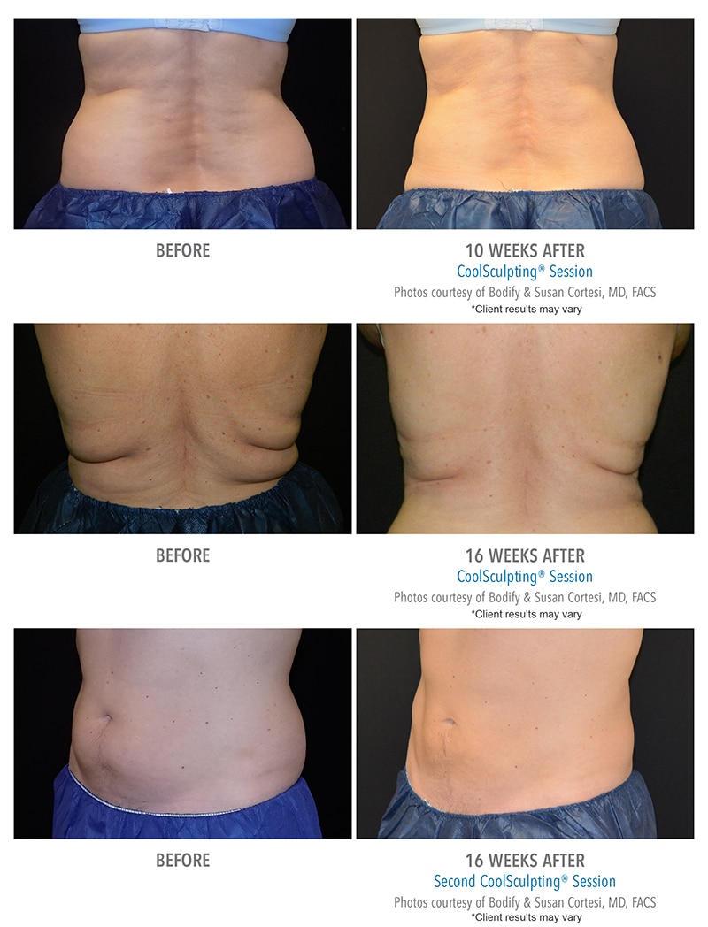 coolsculpting-before-after-photos-client-results-bodify-arizona