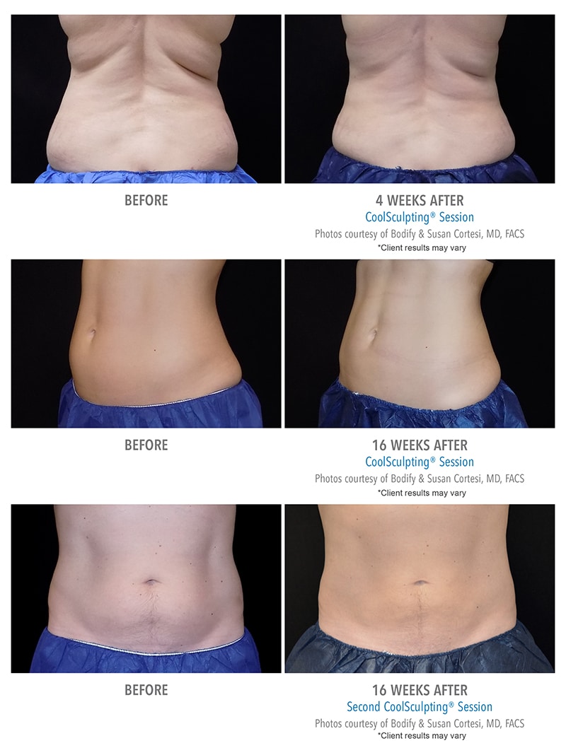 CoolSculpting Before & After Photos Client Results Bodify Arizona