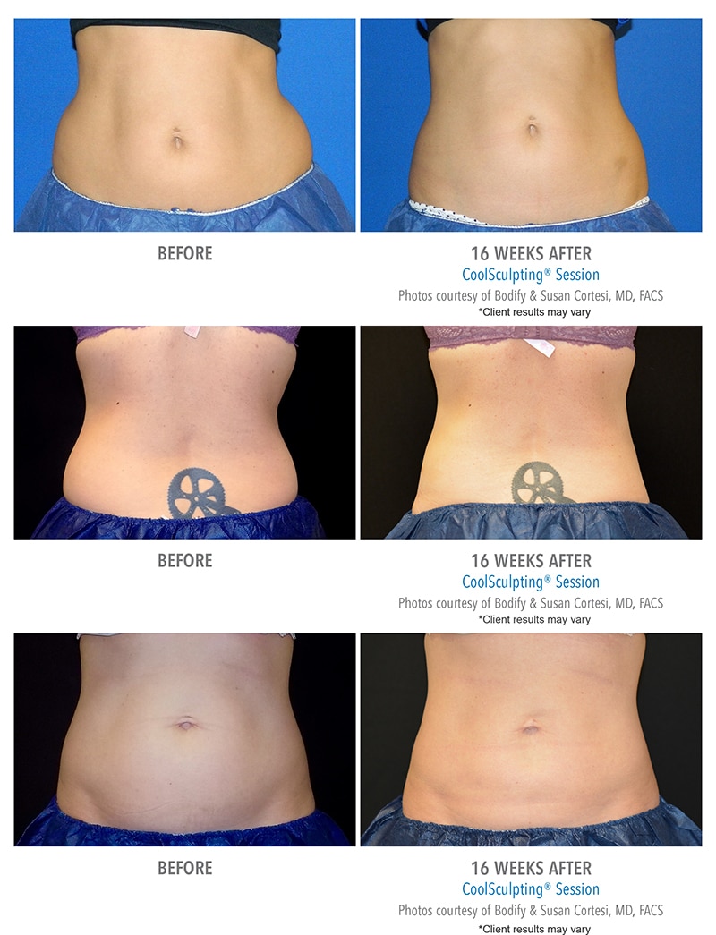 CoolSculpting Before & After Photos Client Results Bodify Arizona