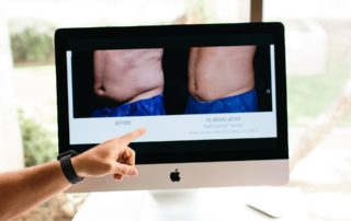 Why CoolSculpting doesn't work