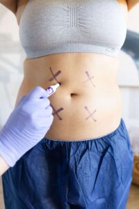 coolsculpting elite non surgical lipo