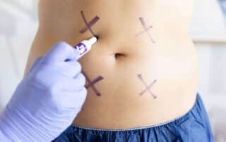 coolsculpting elite non surgical lipo