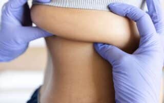 why coolsculpting elite doesn’t leave you with sagging skin