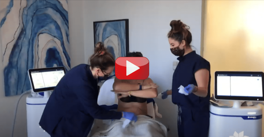 coolsculpting timelapse