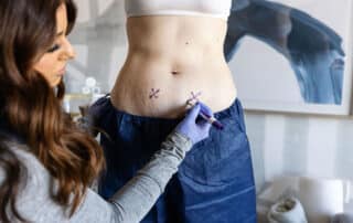 freeze stubborn fat away with coolsculpting elite