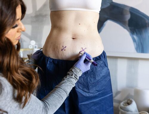 Freeze Stubborn Fat Away With CoolSculpting Elite