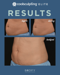 weight loss coolsculpting results