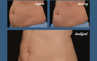 weight loss coolsculpting results