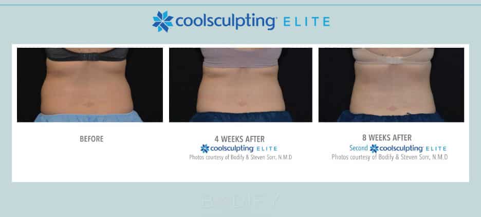 love handles before and after edited