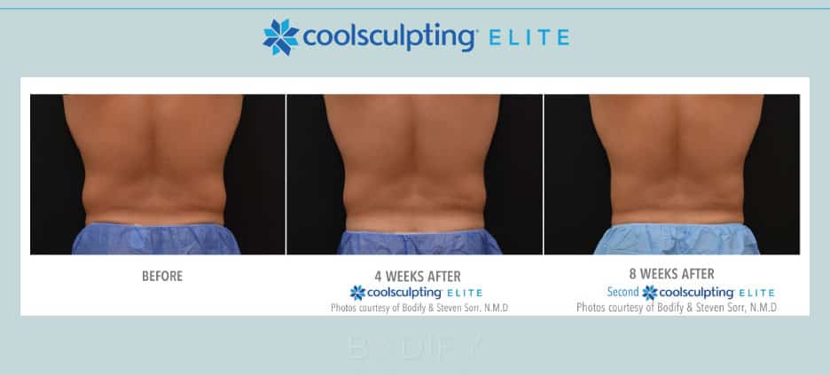 love handles male before and after edited