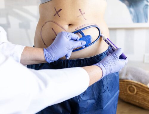 CoolSculpting: The Worthwhile Financial Investment for Body Transformation