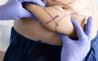 Image about CoolSculpting for Stubborn Fat: Targeting Those Hard-to-lose Areas by Bodify Call Today