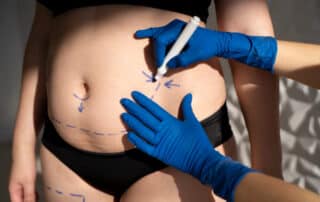 coolsculpting safety understanding the non surgical approach to fat loss