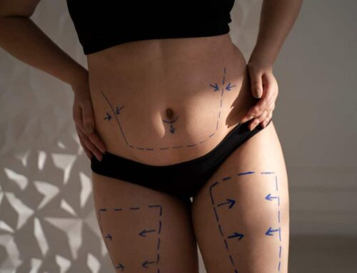 CoolSculpting: The Tough, Burning Questions Answered