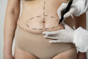 coolsculpting vs. liposuction which is best for you