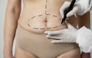 coolsculpting vs. liposuction which is best for you