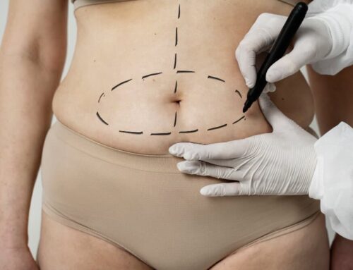 CoolSculpting vs. Liposuction: Which is Best for You?
