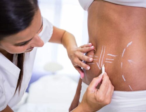 The 5 Most Commonly Treated Areas with CoolSculpting