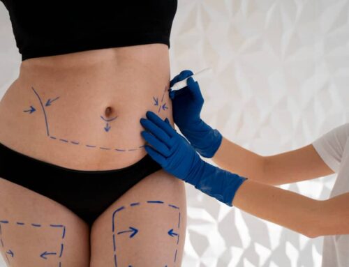 The Ideal Candidate for CoolSculpting: Is It Right for You?