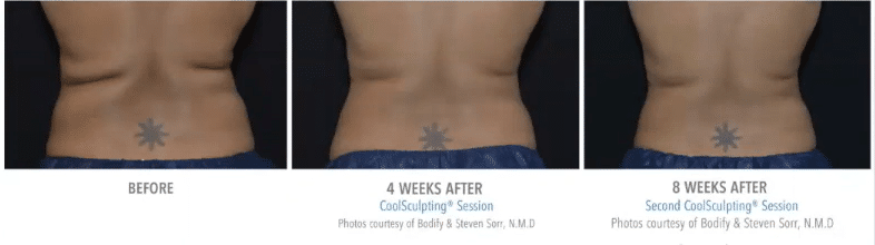 Learn how CoolSculpting reduces bra fat and back bulges. Contact our Scottsdale location at 480-530-0030 to schedule your consultation today.