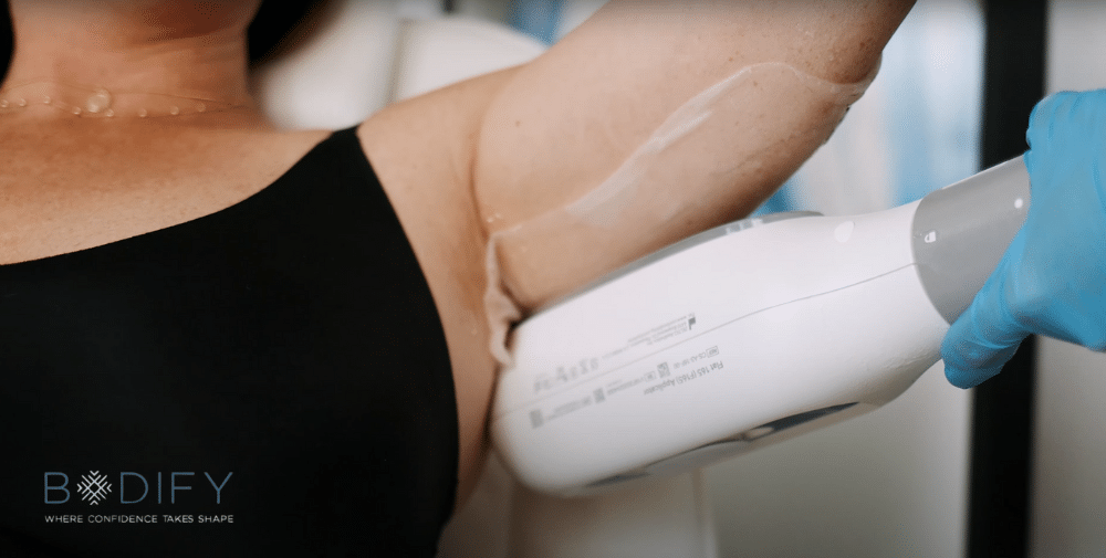 Explore how CoolSculpting complements diet and exercise to target stubborn fat for a sculpted, confident look. Start your journey today with a free consultation.