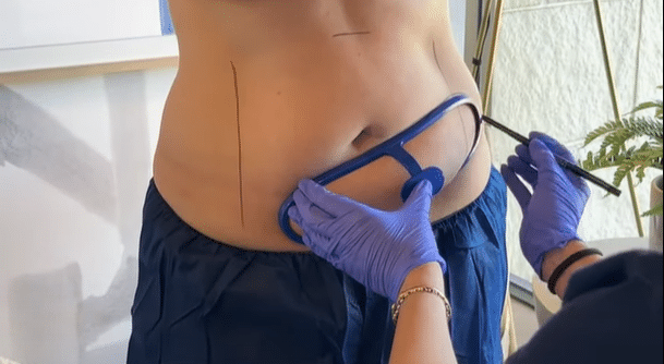 Slim down before your vacation with CoolSculpting! Enjoy safe, effective fat reduction and feel confident in your body. Schedule your consultation today.