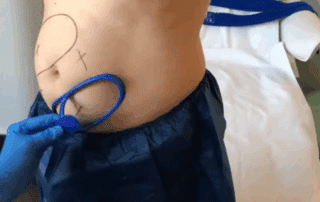 Image of a client undergoing CoolSculpting Elite treatment at Bodify Gilbert—book your consultation today to start your journey towards a more sculpted you.