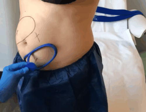 What Makes CoolSculpting a Popular Non-Surgical Body Contouring Option in Gilbert?