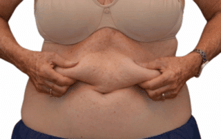 Client reviewing body contouring results from CoolTone and CoolSculpting at a clinic.