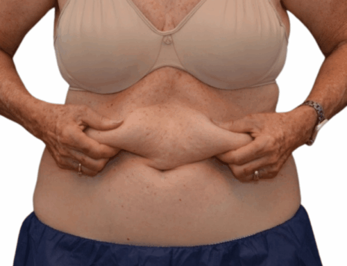 CoolTone vs. CoolSculpting: Toning vs. Fat Reduction Explained