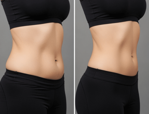 When CoolSculpting Fails: Phoenix Recovery Options